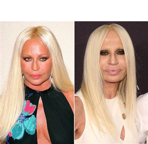 Donatella Versace’s Shocking Plastic Surgery Makeover.